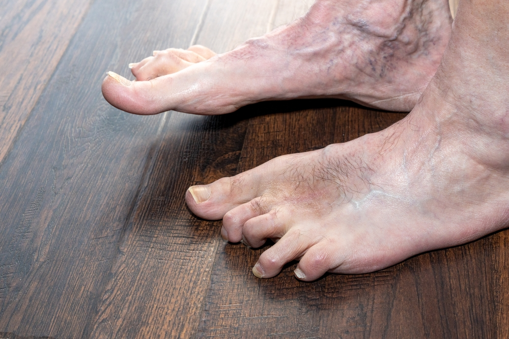 hammertoe treatment in wilmington and inglewood, ca