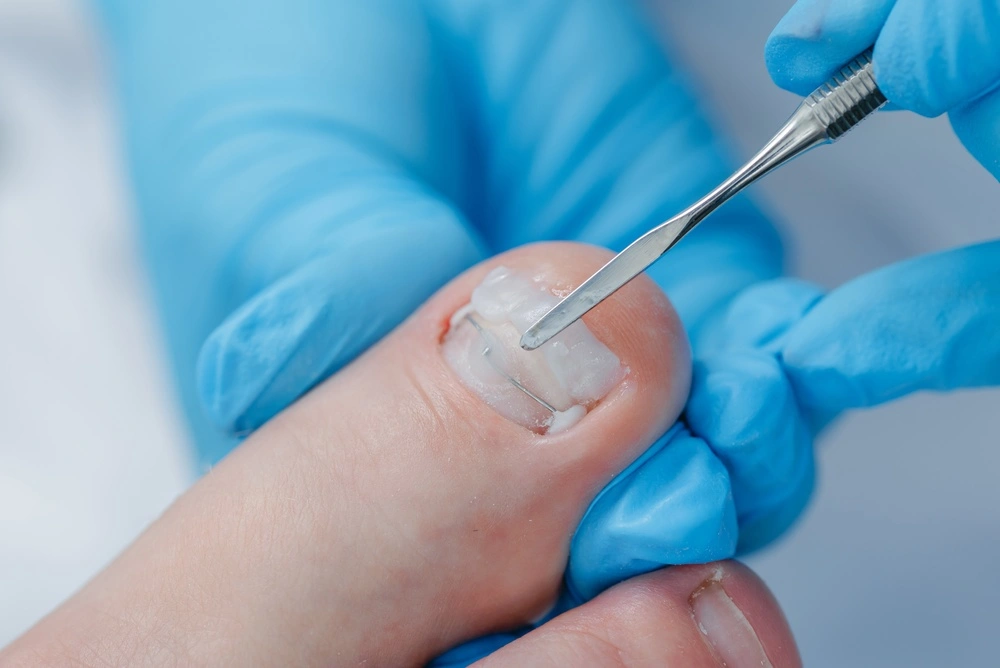 ingrown toenail treatment near you